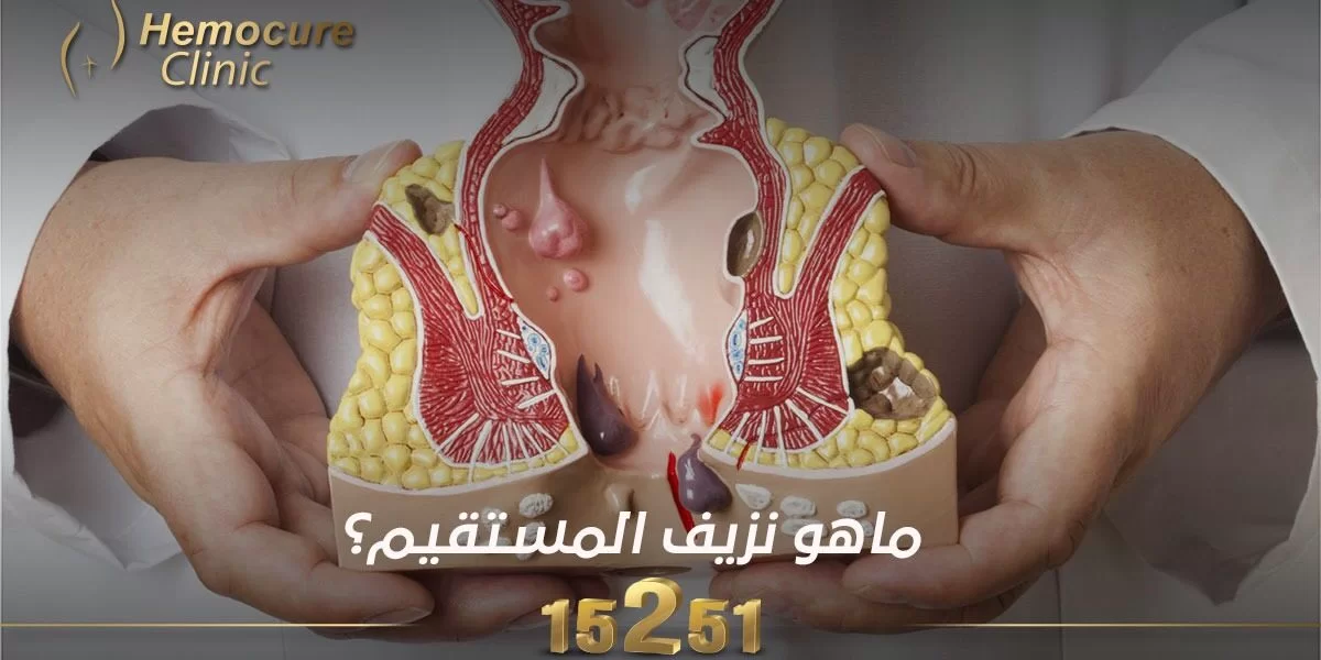 ما هو نزيف المستقيم؟ ما هو نزيف المستقيم؟