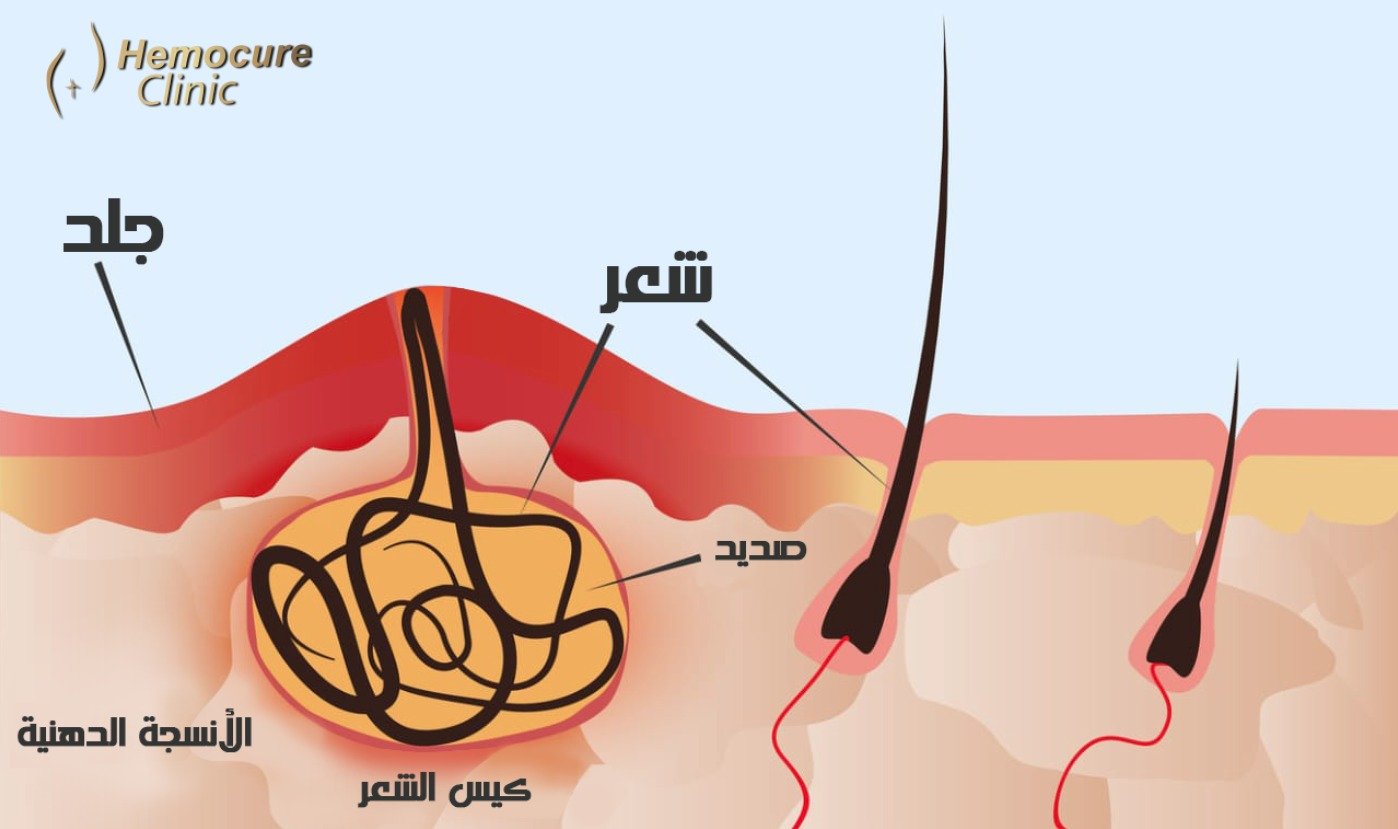 ما هو الناسور العصعصي؟ وكيف يتم علاجه؟ ما هو الناسور العصعصي؟ وكيف يتم علاجه؟