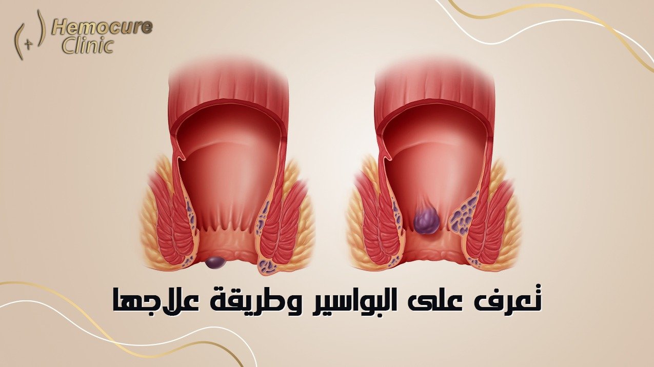 تعرف على البواسير وطرق علاجها والعواقب الخطيرة الناتجة عن إهمال البواسير