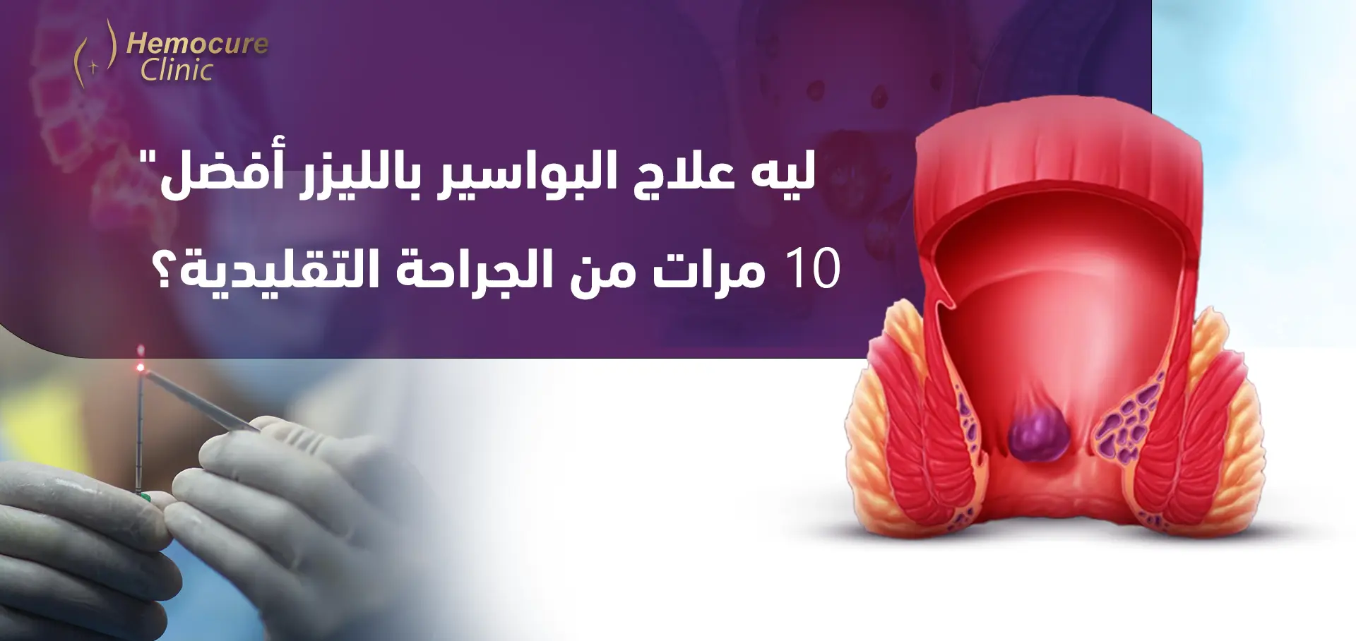ليه علاج البواسير بالليزر أفضل 10 مرات من الجراحة التقليدية؟