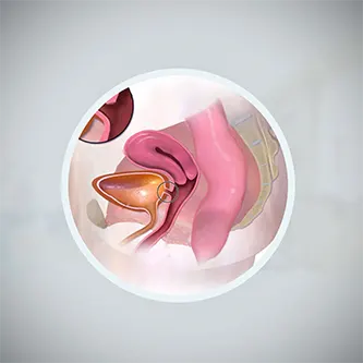 الناسور المهبلي